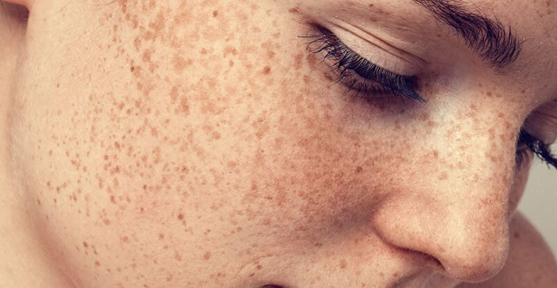 Tàn nhang là các đốm nâu nhỏ, màu vàng nhạt xuất hiện tại nhiều điểm trên da